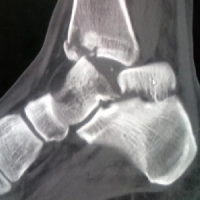 Lesiones complejas del pie y tobillo